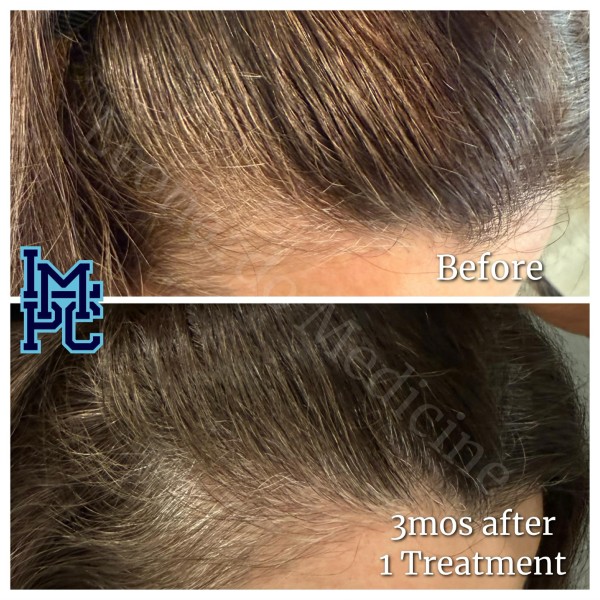 Needleless Hair treatment case 14
