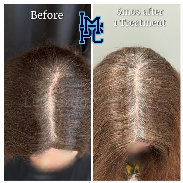 Needleless Hair treatment case 24