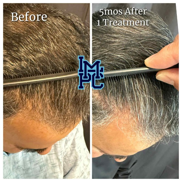 Needleless Hair treatment case 4