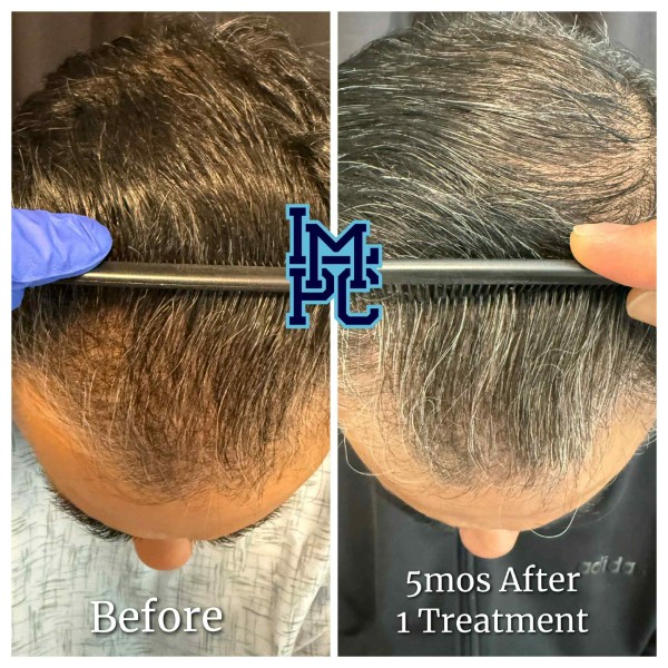 Needleless Hair treatment case 7