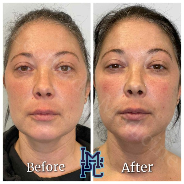 Pan Face Filler treatment 10