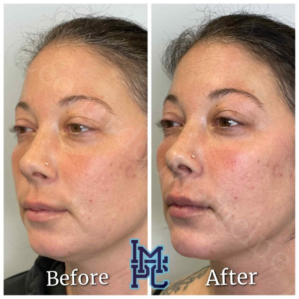 Pan Face Filler treatment 11