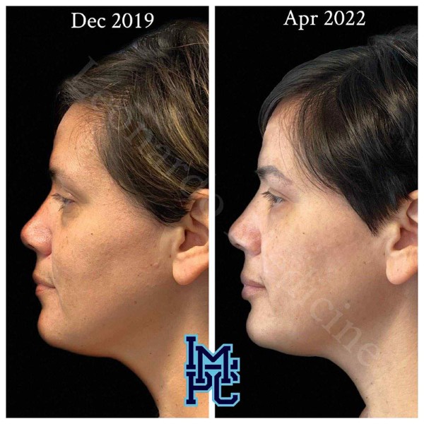 Pan Face Filler treatment 20