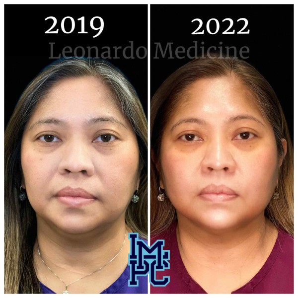 Pan Face Filler treatment 23