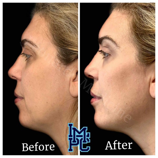 Pan Face Filler treatment 4