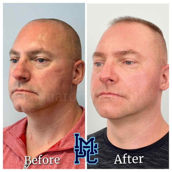 Pan Face Filler treatment 6