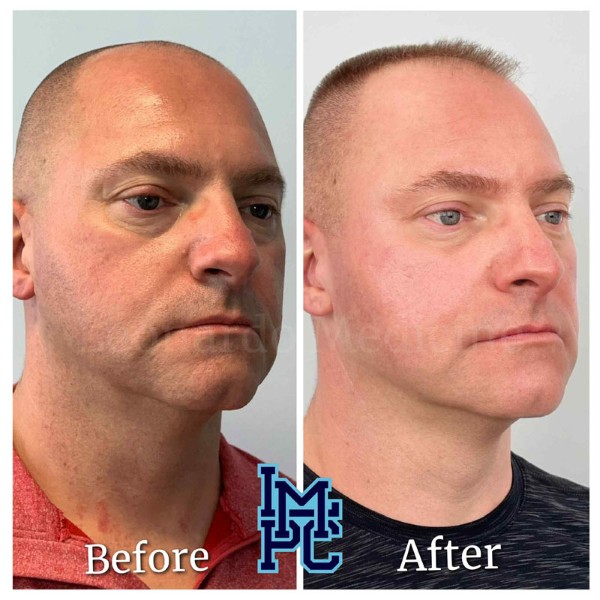 Pan Face Filler treatment 7