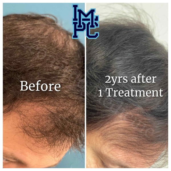 PRP Hair Treatment case 1