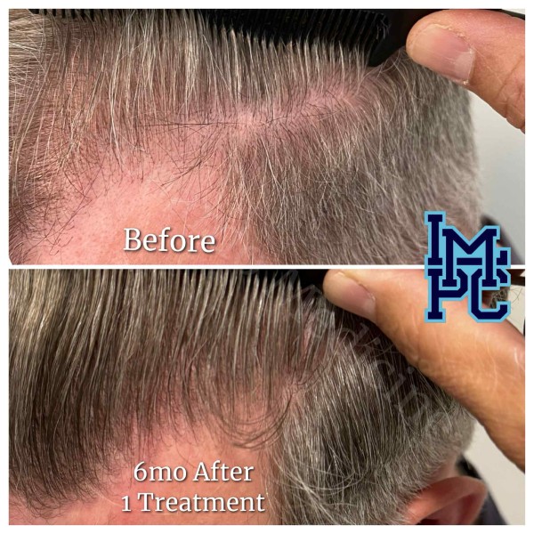 PRP Hair Treatment case 11