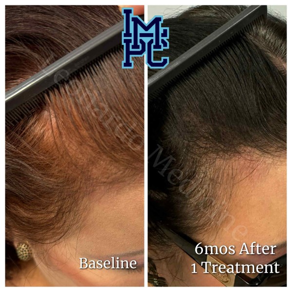 PRP Hair Treatment case 5
