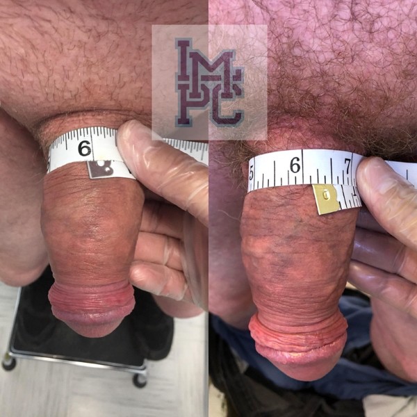 Priapus® Shot treatment case 1