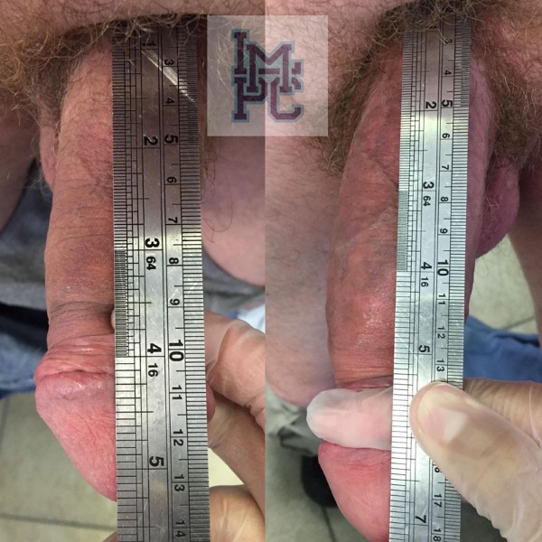 Priapus® Shot treatment case 2