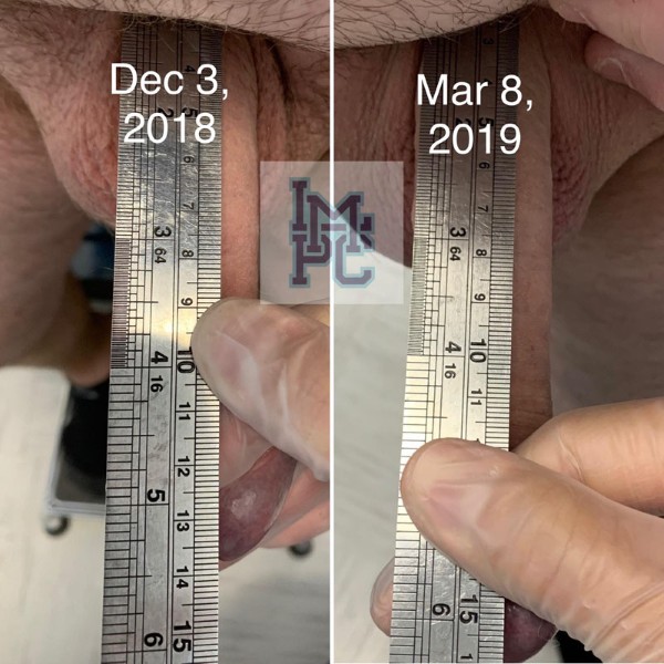Priapus® Shot treatment case 4