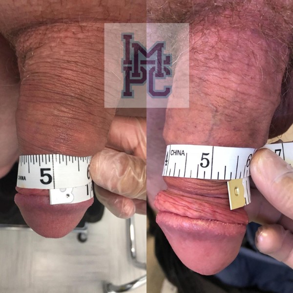 Priapus Shot treatment case 9