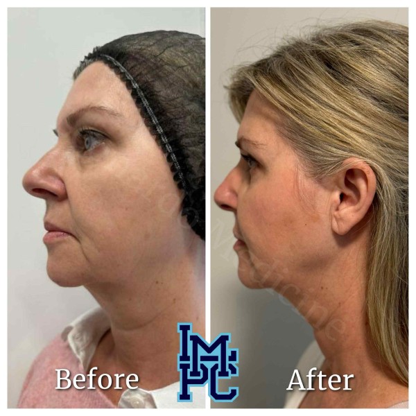 Radiesse® treatment 10