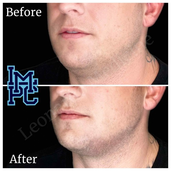 Radiesse® treatment 13