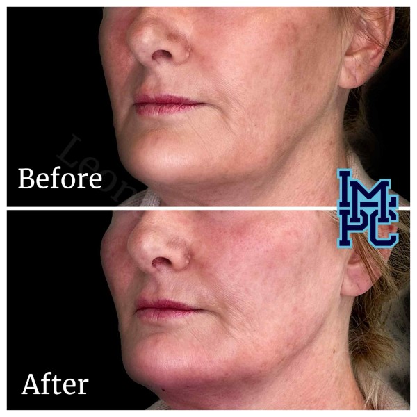 Radiesse® treatment 14