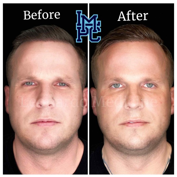 Radiesse® treatment 17