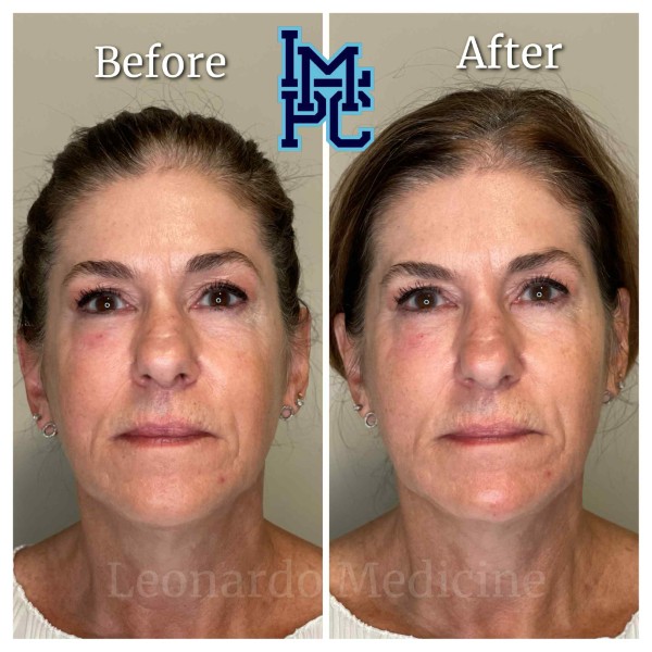 Radiesse® treatment 20