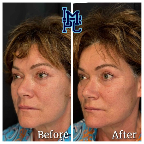 Radiesse® treatment 23