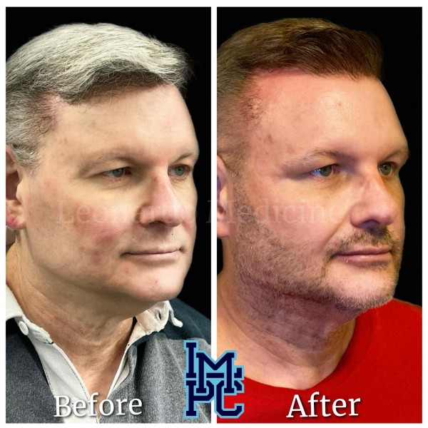 Radiesse® treatment 4