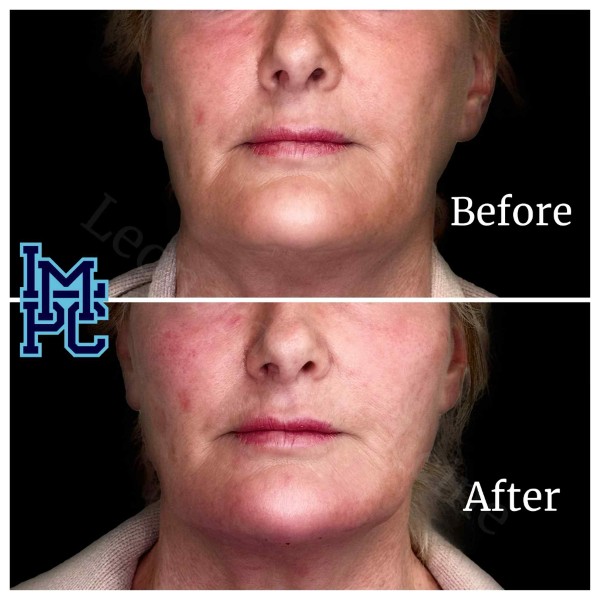 Radiesse® treatment 7