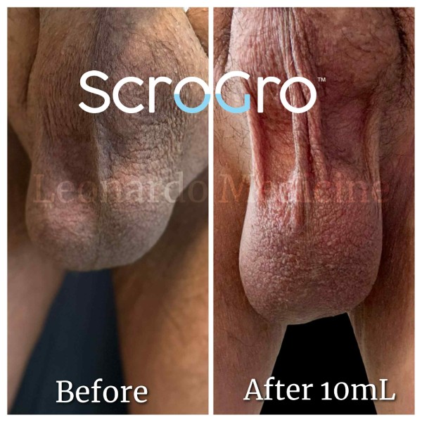 ScroGro™ Filler treatment 1