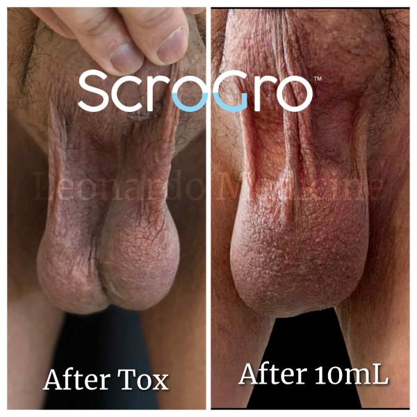 ScroGro™ Filler treatment 2