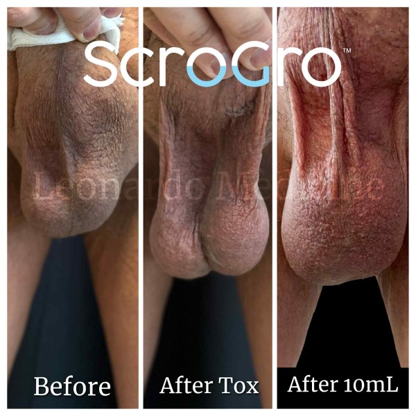 ScroGro™ Filler treatment 4