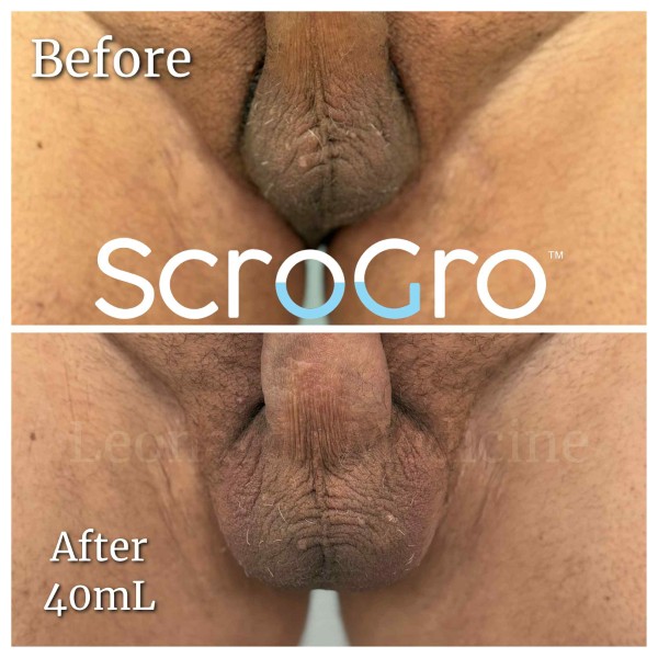 ScroGro™ Filler treatment 7