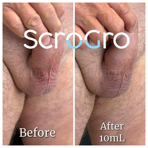 ScroGro™ Filler treatment 9
