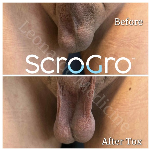 ScroTox™ Tox treatment 1