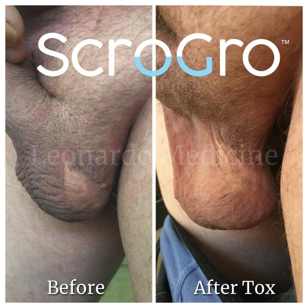 ScroTox™ Tox treatment 13