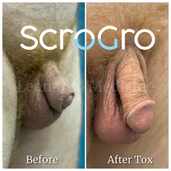 ScroTox™ Tox treatment 2
