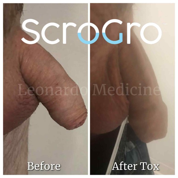 ScroTox™ Tox treatment 4