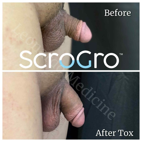 ScroTox™ Tox treatment 5