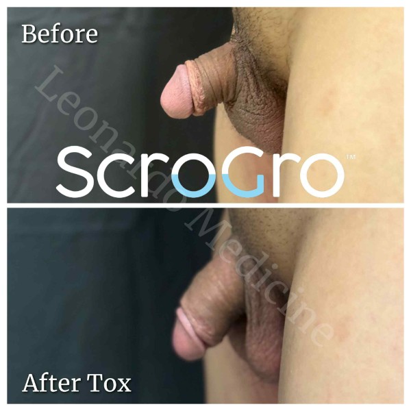 ScroTox™ Tox treatment 6