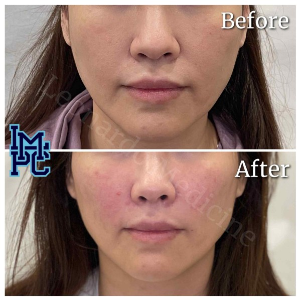 Sculptra® treatment 2