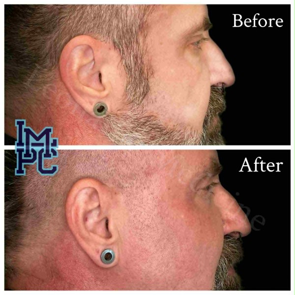 Sculptra® treatment 8