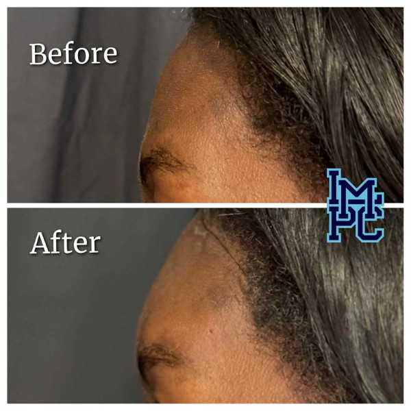 Upper Face Filler treatment 1
