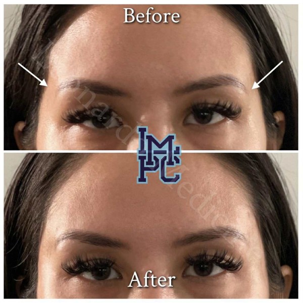 Upper Face Filler treatment 10