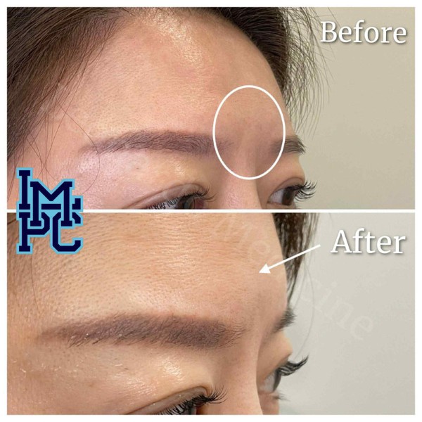 Upper Face Filler treatment 14