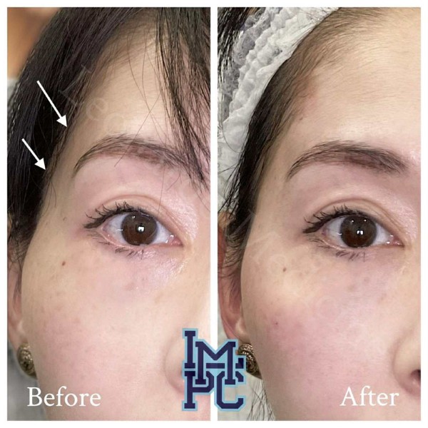Upper Face Filler treatment 16