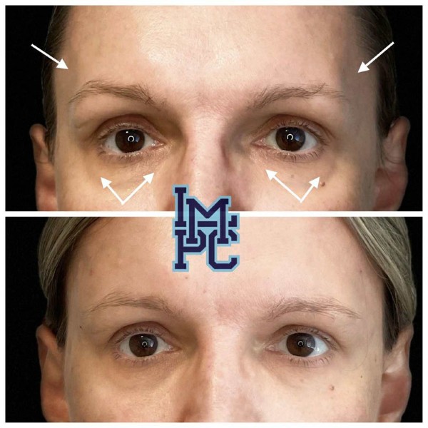 Upper Face Filler treatment 29