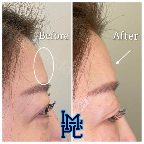 Upper Face Filler treatment 7