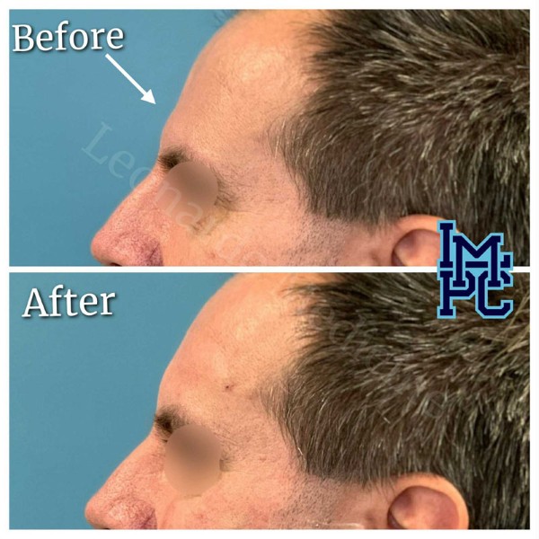 Upper Face Filler treatment 9