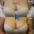Vampire Breast Lift treatment 6 thumbnail