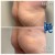 Butt Lift treatment 1 thumbnail