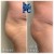 Butt Lift treatment 10 thumbnail