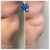 Butt Lift treatment 11 thumbnail